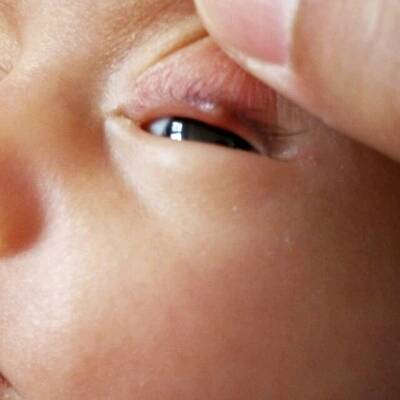 宝宝眼睛上长了痘痘,有点像小泡怎麼办