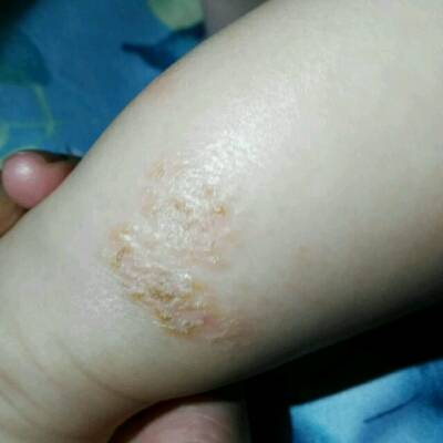小孩湿疹腿部图片
