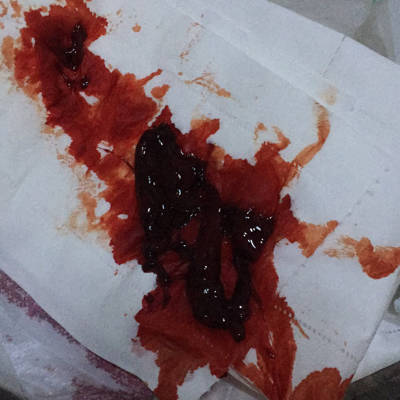 月经期间排出血块图图片