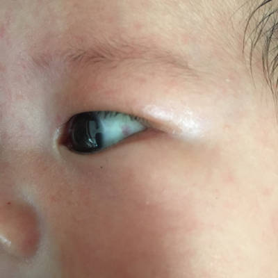 婴儿眼白有红血斑图片图片