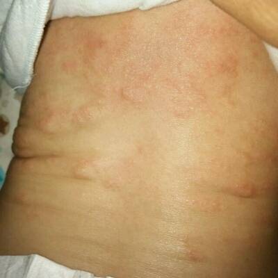 母乳性湿疹的特征图片