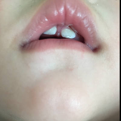 宝宝快九个月了,长了5颗牙,但是上面两颗分得好开,这种以后能不能长拢