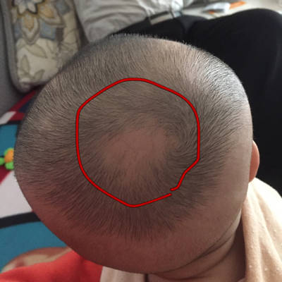 有宝妈知道这是什麼原因吗,宝宝头顶上这一块头发一直不长,出生的时候