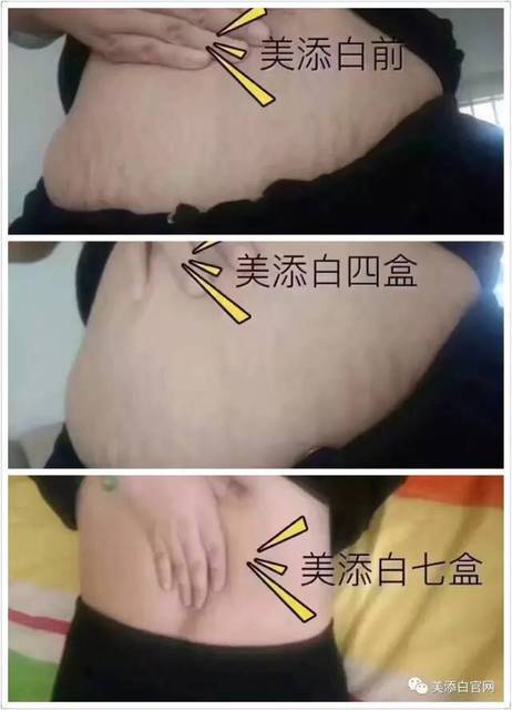 妊娠纹修复新进展:从传统疗法到现代科技