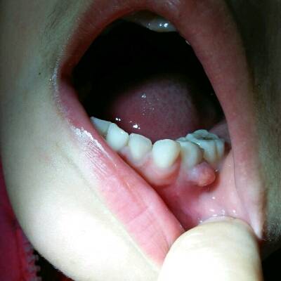 五岁小孩下牙龈上长了一个红红的小肉瘤,摸上软软的不痛不痒是怎麼