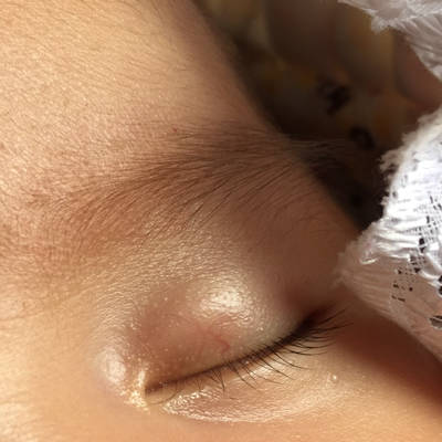 新生儿黑眼球旁有血条图片