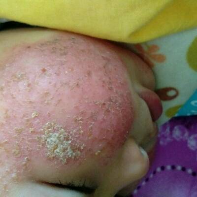 孩子脸老是反覆长湿疹 有时痒的睡不好 爱抓 心痛 求方法