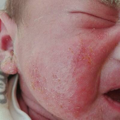 婴儿脸部长湿疹图片图片