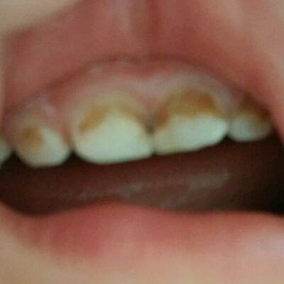 宝宝28个月,上面四颗牙齿坏了,看上去牙齿被腐蚀一层,怎麼办啊