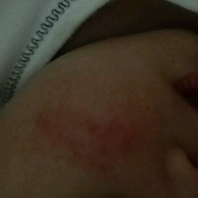请问我家宝宝脸上的是热疹还是湿疹呢?
