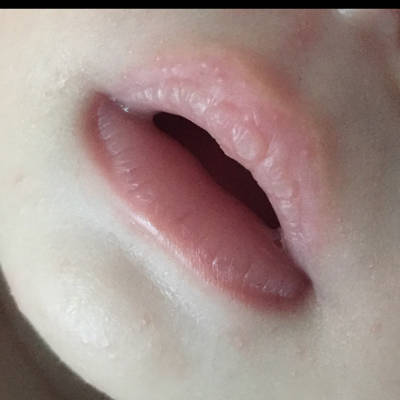 小孩嘴唇上长疱疹图片图片