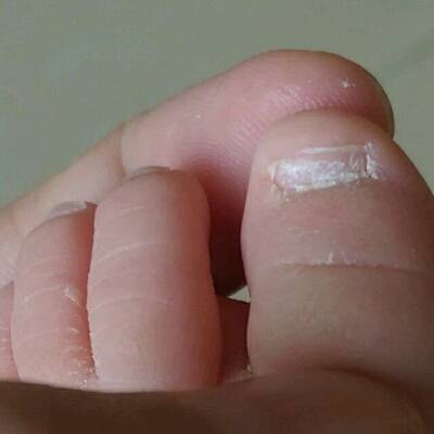 宝宝从出生到现在脚指甲就像长灰指甲一样,灰指甲会遗传吗?