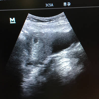 早期怀孕彩超图片图片