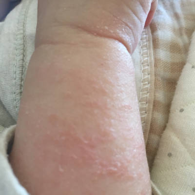 婴儿严重湿疹图片图片
