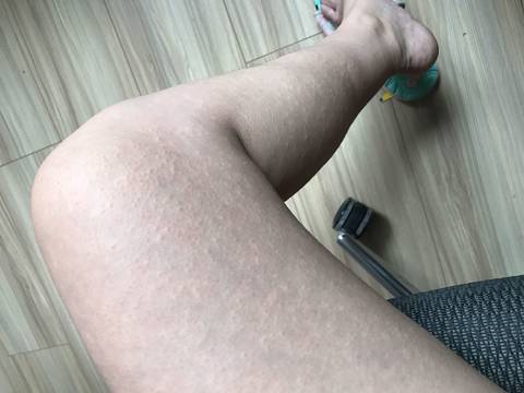 孕晚期腿上起了好多疹子(有图慎点)