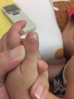 急,我儿子22个月了,最近手指甲竟然会从月牙位置指甲空心,进而引发