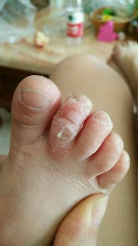 宝宝两岁零八个多月,脚趾头脱皮,开裂,手指尖也脱皮是怎麼回事