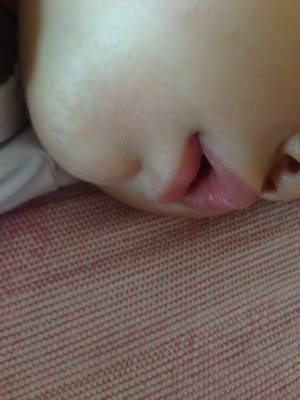 宝宝嘴唇有红点点图片图片
