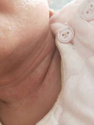 宝宝脖子长脂肪粒图片图片