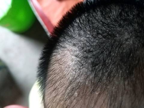 宝宝头皮上有跟头皮屑样的东西是什麼啊