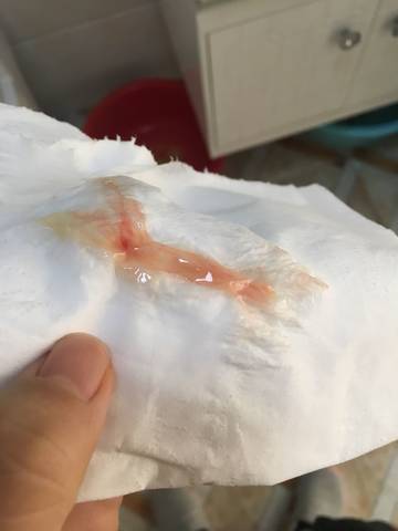 慎入!剖腹产两个半月,流了点血伴有粘稠东西