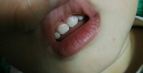 一岁半宝宝牙齿有个黑洞,还钙化啦!