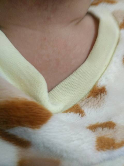 有人说是汗斑,有人说是黑色素缺少,有的说没事,请问宝妈们你们的宝宝