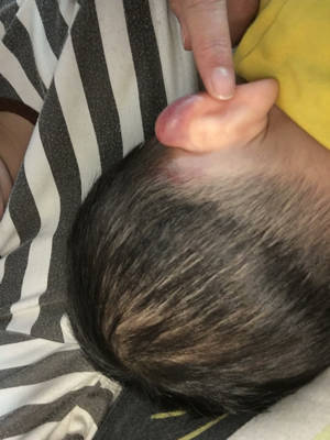 宝宝耳朵上紫黑淤血图图片