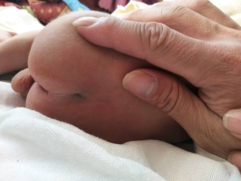 新生儿腰骶部凹陷图片图片