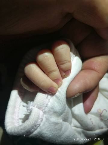 宝宝手指甲上有黑色结痂是怎麼回事?