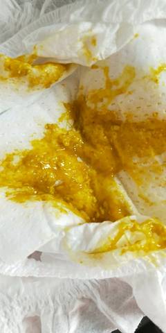三个月的宝宝混合喂养,大便次数多,前后拉成这样,而且放屁带水,今天