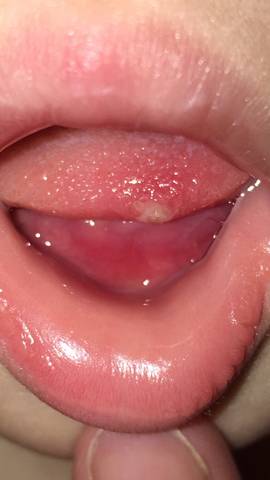 孩子舌头溃疡图片图片