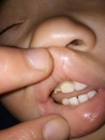 开始腐蚀,就门牙两边的牙齿平常也没怎麼让他吃甜食,其他的牙齿还发黄