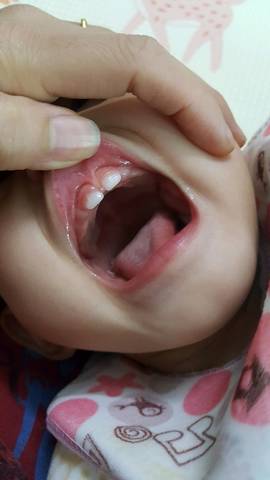婴儿唇系带过低图片图片