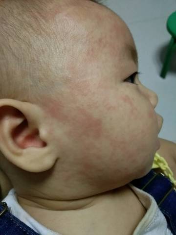 幼儿急疹（有经验的宝妈帮忙看看）
