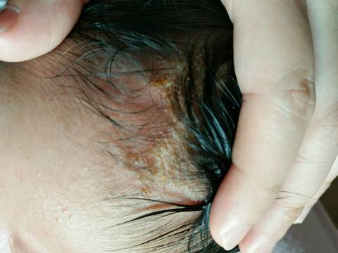 湿疹引起的头垢图片图片