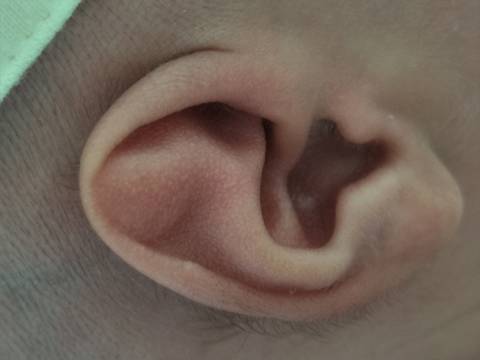 宝宝耳朵畸形怎麼办?