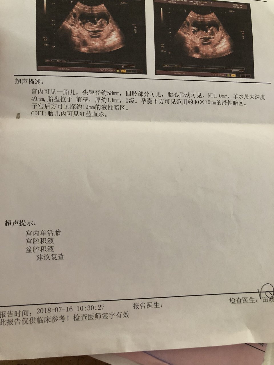 16周流姨妈血 一直有宫腔积液  好担心