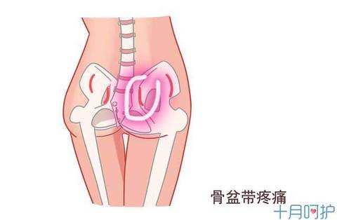 有没有孕中期盆骨带疼痛的 14周6天 走路右脚踩下去就痛 已经没办法走路了 怎么办呀 宝宝树