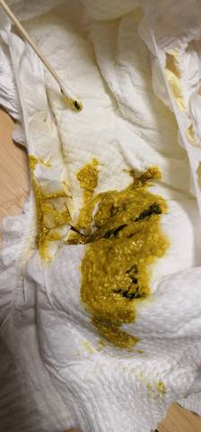 宝妈们,5个半月的宝宝拉便便里有黑色条状的东西,是什么呀?