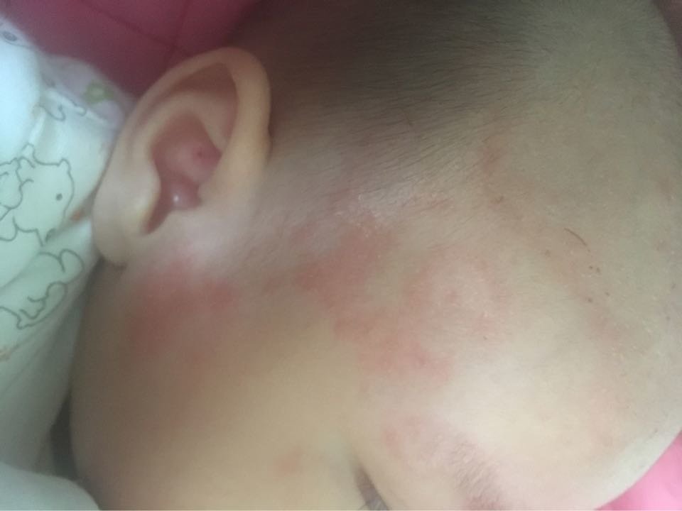我女儿脸上长了很多一圈圈红点