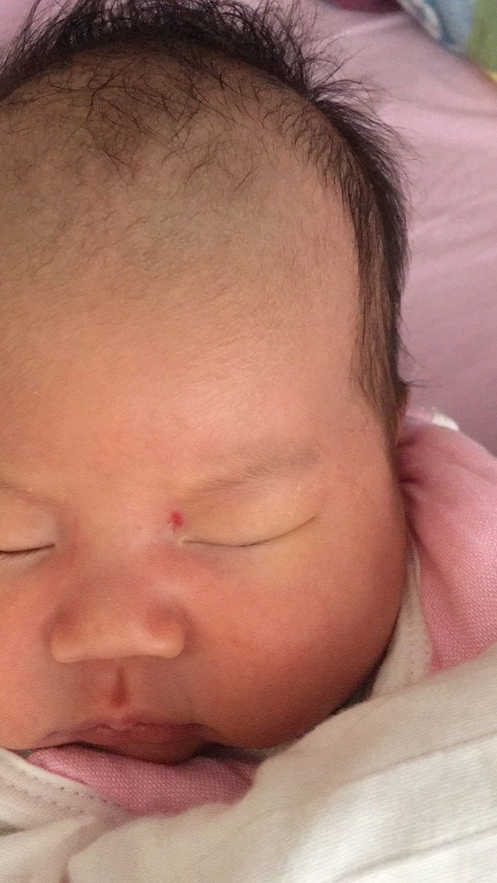 有血管瘤的宝宝吗