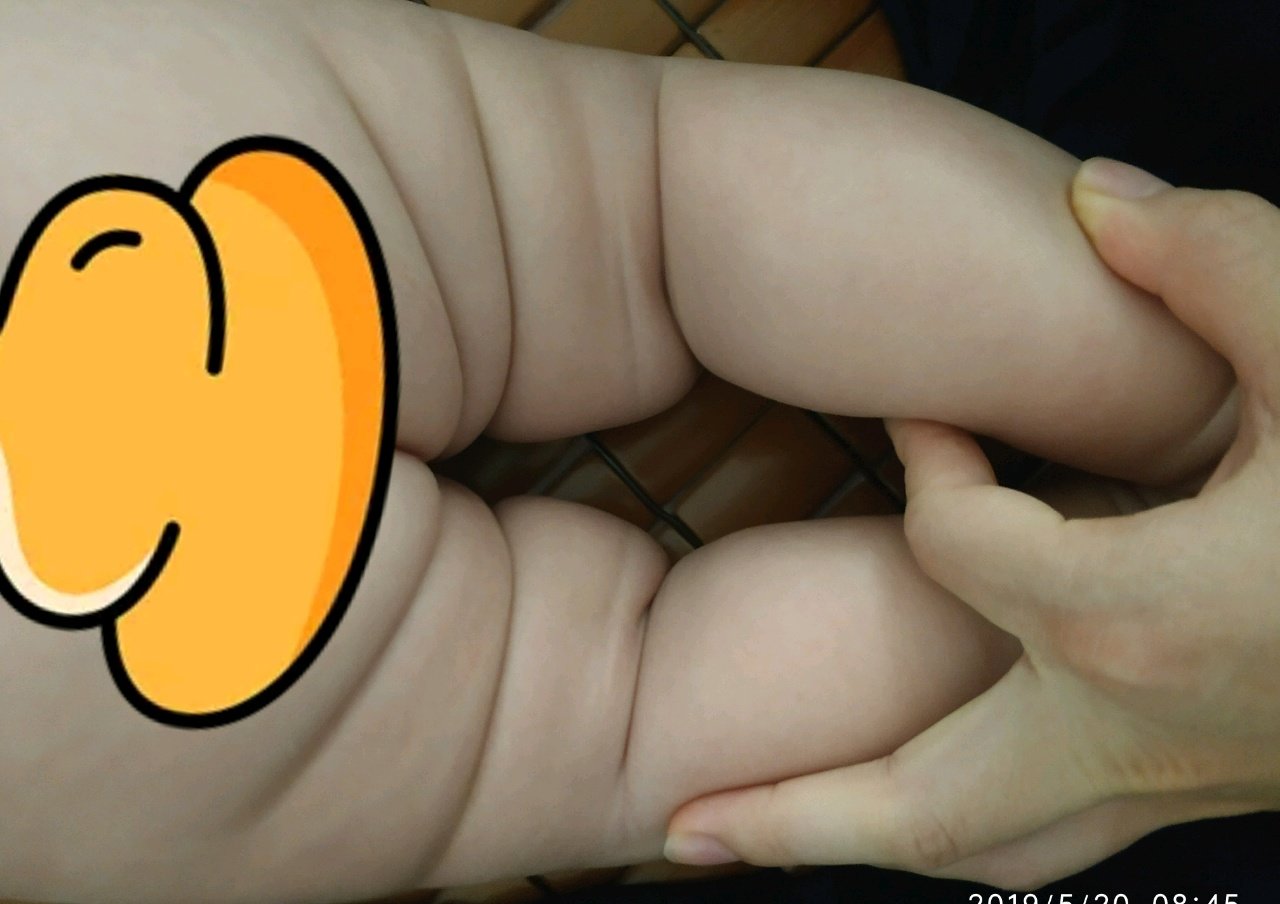 宝宝腿纹