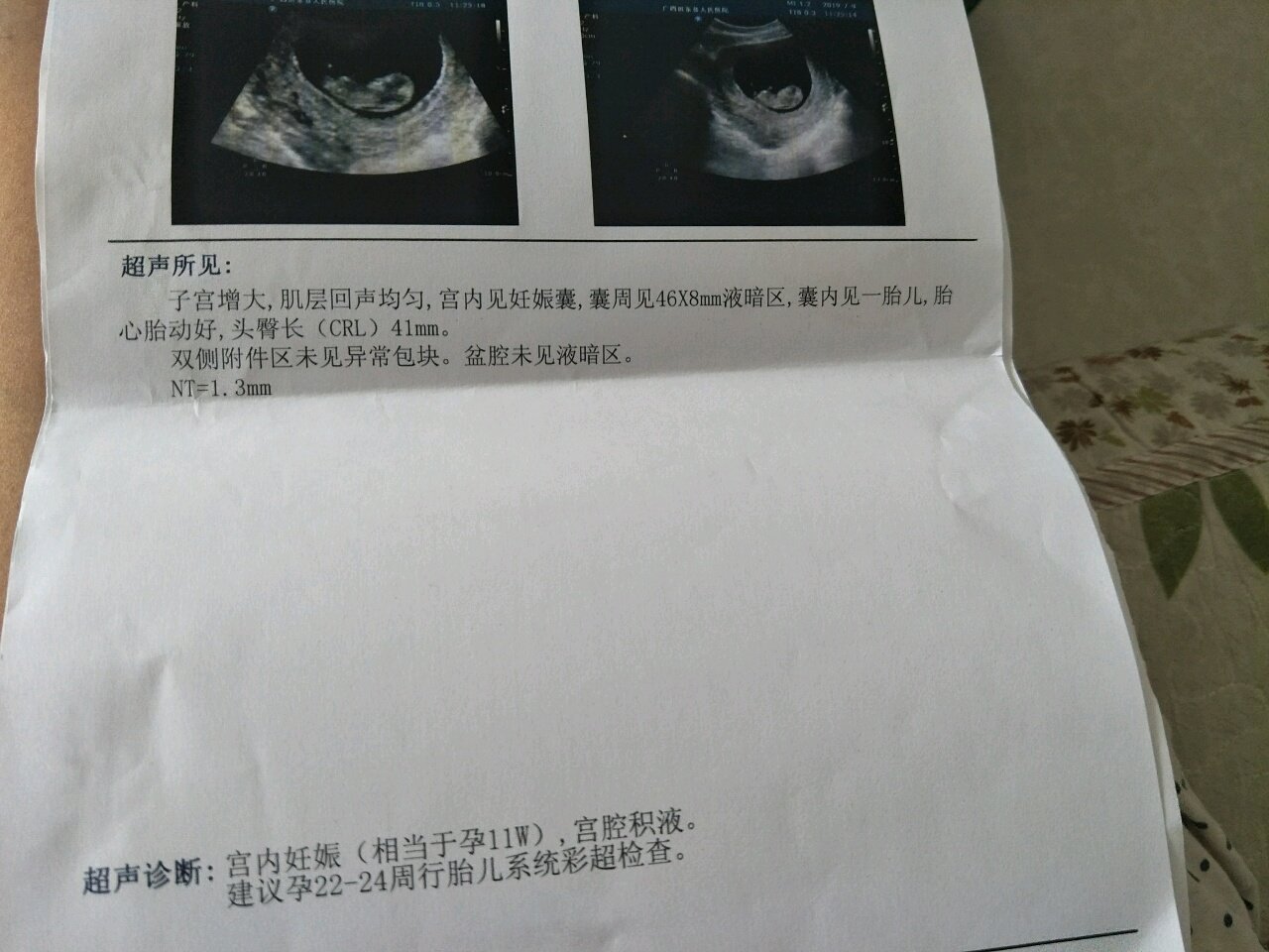 临床诊断12周了，B超小了一周,是不是相当于11周做的NT
