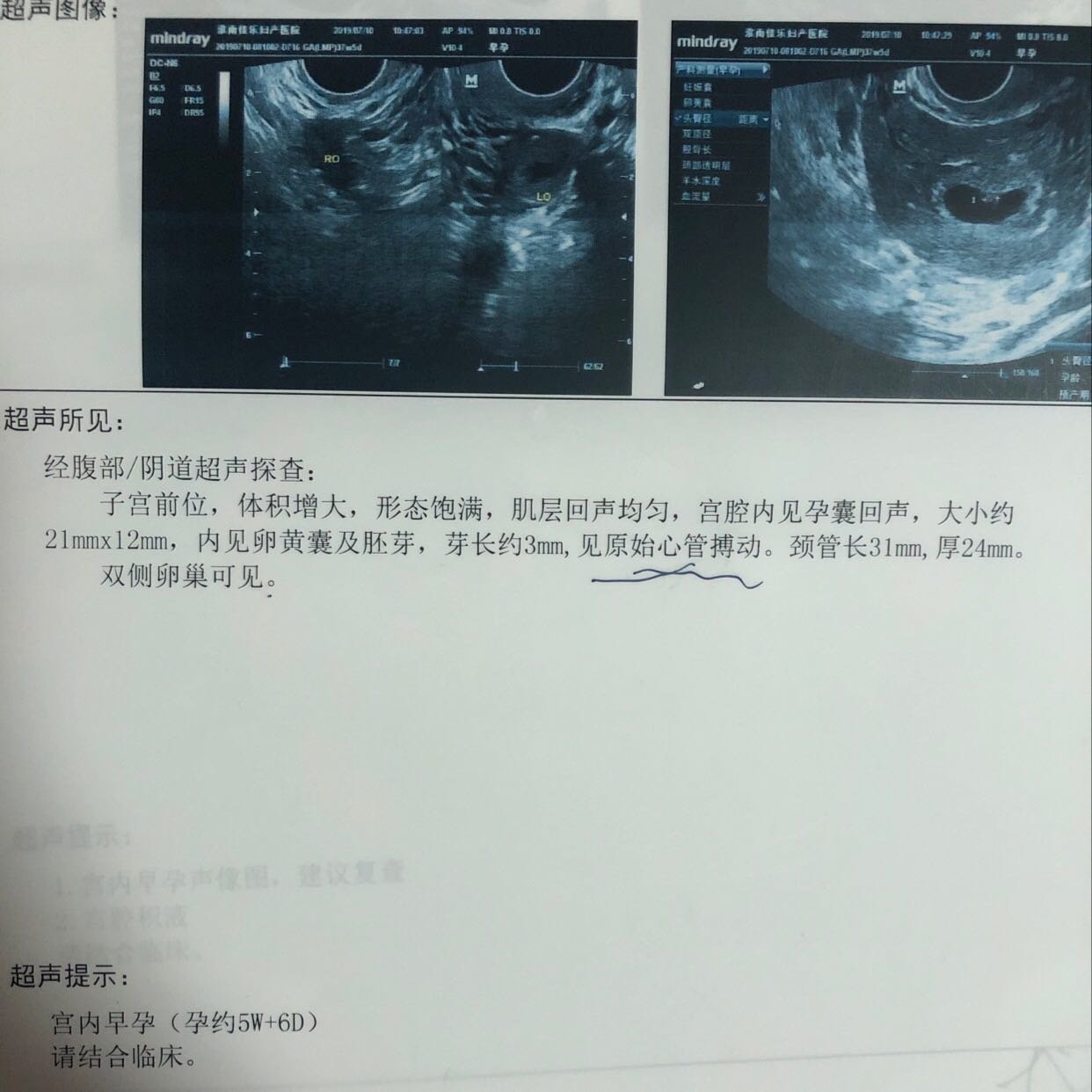 【新手报到】想问问各位宝妈，我这比超正常吗，