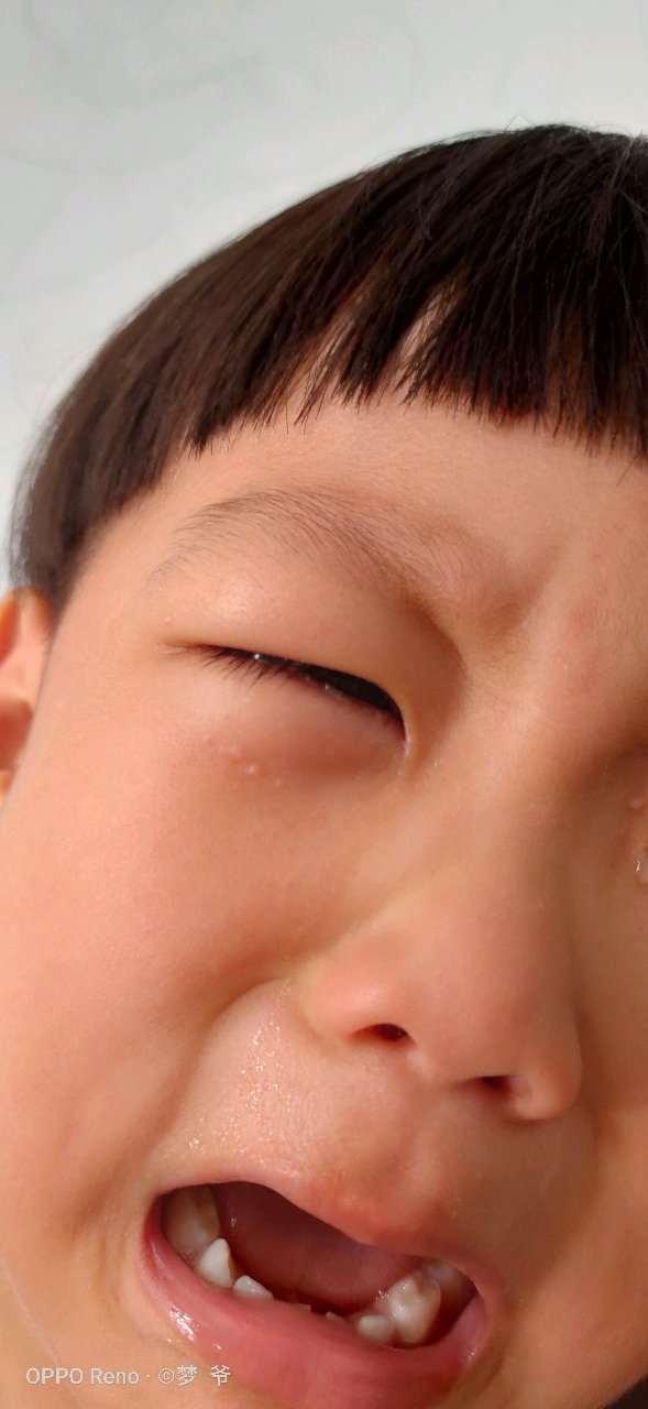 三岁宝宝脸上起来白色疙瘩