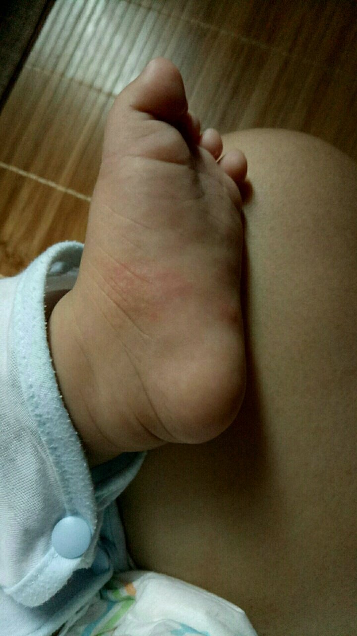 宝妈知道这是什么？一早醒来发现这个不知是被什么咬了，还是什么