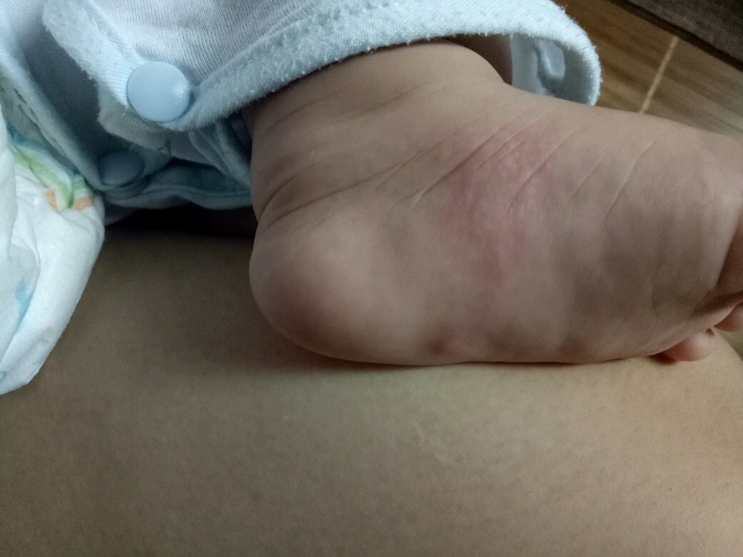 宝妈知道这是什么？一早醒来发现这个不知是被什么咬了，还是什么