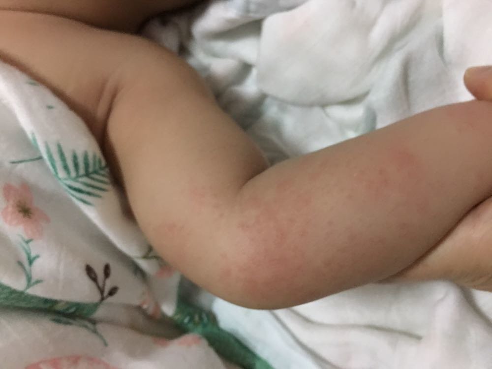 红疹，痱子还是啥，有懂得宝妈吗