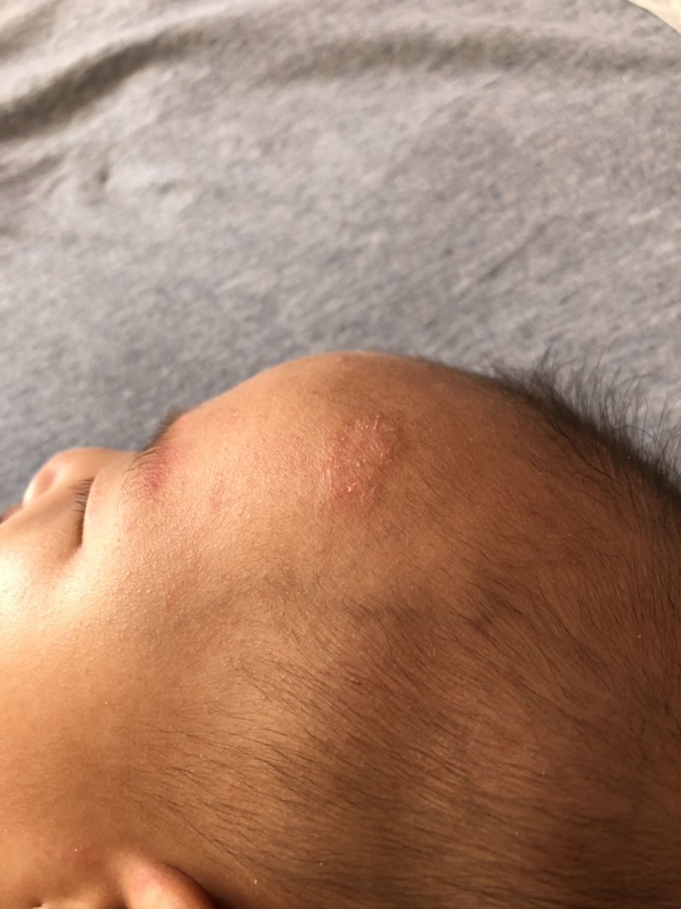 宝宝额头上长的癣嘛？